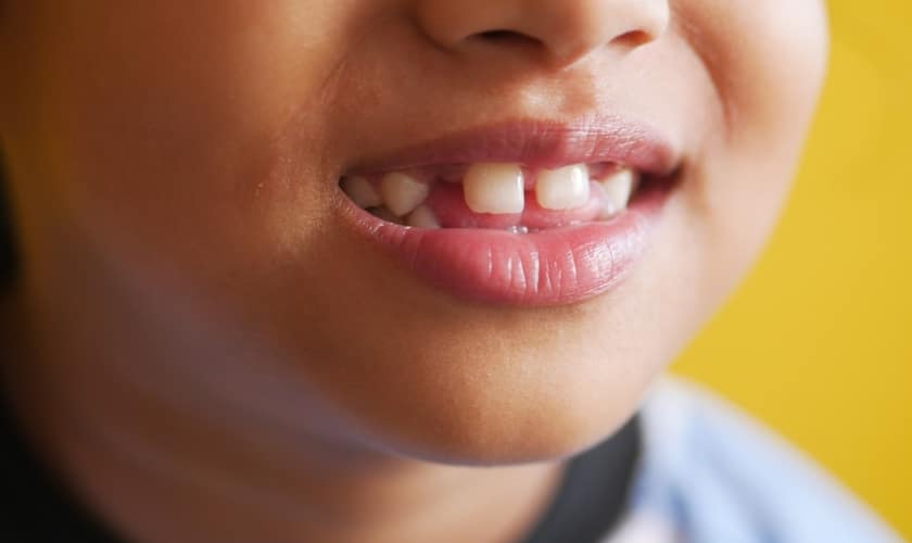 space maintainer necessary after your child loses a baby tooth